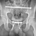 Postoperative radiograph in this patient.