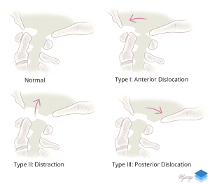Types of craniocervical dislocation.