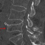Red arrow: L5 compression fracture confirmed on subsequent CT.
