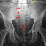 Red arrows: sacral fracture. Yellow arrow: left L5 transverse process fracture.