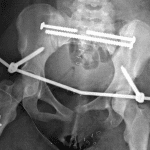 Postoperative radiograph in this patient showing extensive internal and external fixation.