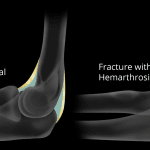 Elbow joint effusion.