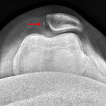 Sunrise view shows lateral patellar subluxation and a medial patellofemoral ligament (MPFL) avulsion fracture (red arrow).