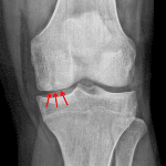 Red arrows: medial femoral condyle OCL on the frontal view.
