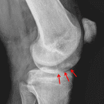 Red arrows: medial femoral condyle OCL on the lateral view.