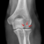 Red arrows: osteochondral lesion in the capitellum.