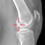 Red arrows: osteochondral lesion in the posterior aspect of the lateral femoral condyle.