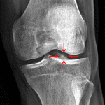 Red arrows: displaced loose osteochondral fragment.