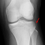 Red arrow - acute avulsion fracture along the lateral tibial plateau (Segond fracture)