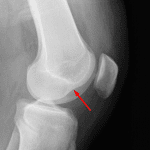 Red arrow - Deep lateral femoral notch sign