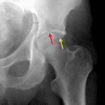 Associated both column left acetabular fracture with fractures extending into the superior (red arrow) and posterior (yellow arrow) acetabular walls. Blue dotted line indicates degree of displacement of the column fractures.