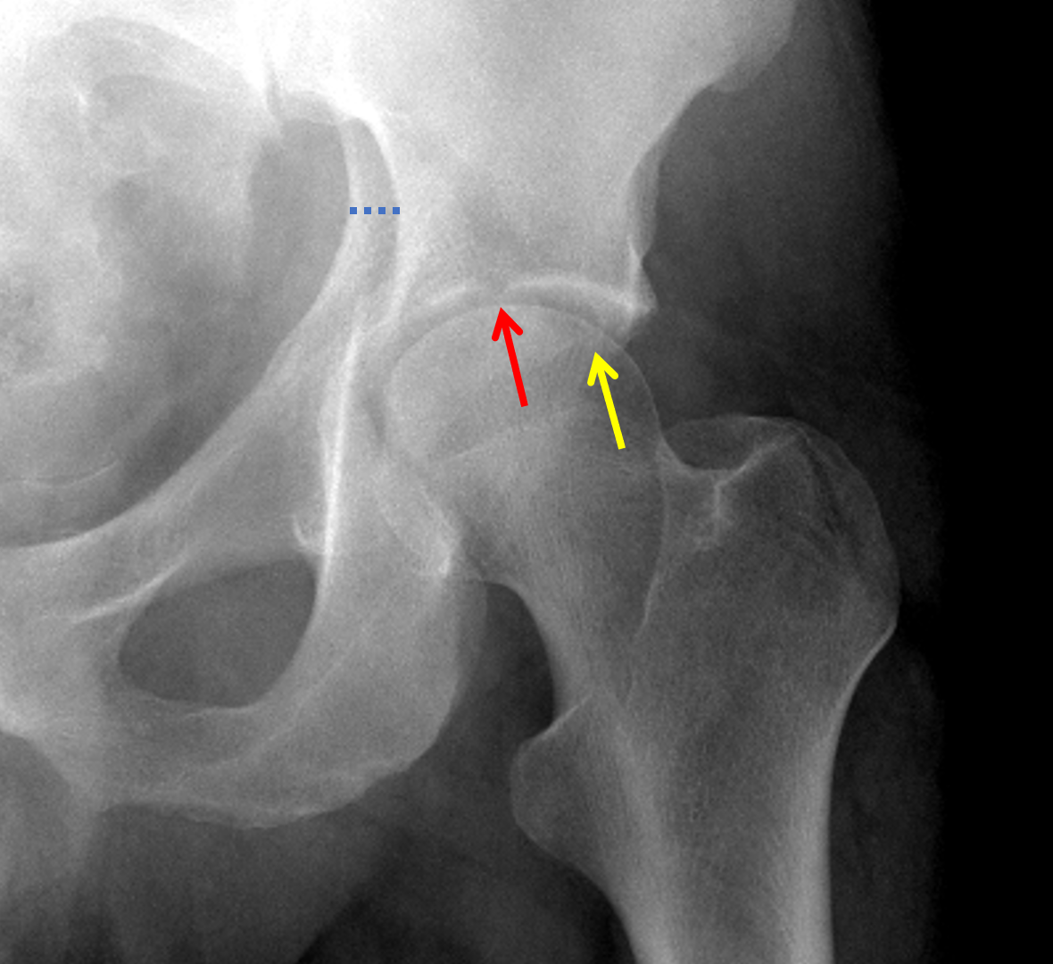 Anterior Column Acetabular Fracture