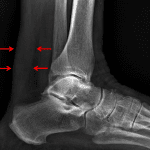 Red arrows: thickening of the Achilles tendon.
