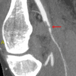 Anterior knee dislocation: sagittal maximum intensity projection (MIP) image from a CTA shows proximal popliteal artery injury (red arrow) in this patient.