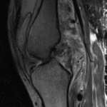 Anterior knee dislocation: follow-up MRI shows complete ACL and PCL tears, as demonstrated on this representative sagittal T2-weighted image.