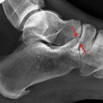 Red arrows: minimally displaced anterior process of calcaneus fracture.