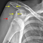 Red arrow: displaced fracture of the greater tuberosity. Yellow arrows: fat-fluid levels indicative of lipohemarthrosis.