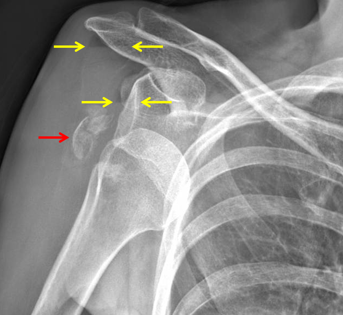 Shoulder Dislocation With Fracture