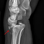 Barton fracture with dorsal displacement (red arrow).