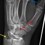 Red arrows: nondisplaced fracture of the trapezium. Yellow arrow: ulnar styloid fracture. Blue arrow: impacted second metacarpal neck fracture.