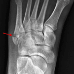 Red arrow: mildly displaced intraarticular fracture at the base of the fifth metatarsal.