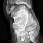 Red arrow: avulsion fracture at the base of the fifth metatarsal.