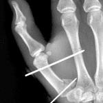 Followup radiograph in this patient after percutaneous pinning.