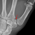 Red arrow: displaced Bennett fracture.