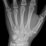 Postsurgical radiograph in this patient.