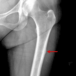Atypical femoral fracture related to bisphosphonate use. Red arrow: focal cortical thickening of the lateral subtrochanteric femur.