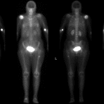 Bone scan in this patient shows increased uptake in the region of the fracture. The patient also has horrible right shoulder degenerative changes.