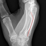 Boxer's fracture: red dotted line demonstrates volar tilt of the distal fracture fragment.