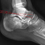 Depressed calcaneal fracture in this case with Boehler's angle measuring less than 20 degrees.
