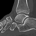 Chopart dislocation confirmed on this patient's subsequent CT. A portion of the cuboid is perched on the anterior process of the calcaneus.