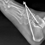 Postoperative radiograph in this patient showing reduction and percutaneous pin fixation of the Chopart interval.