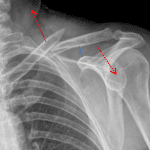 Acute clavicle fracture with separation of the fracture fragments by the upward pull of the sternocleidomastoid and downward pull of the arm (red arrows). Normal coracoclavicular distance (blue line).