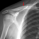 Red arrow: nondisplaced midshaft clavicle fracture.