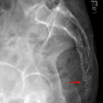 Red arrow: buckle fracture of the anterior cortex of the first coccygeal segment.