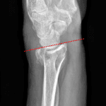 Colles fracture: lateral view shows mild dorsal tilt of the distal radial articular surface (red dotted line).