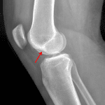 Red arrow: deep lateral condylar notch consistent with impaction fracture.