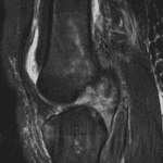 Subsequent MRI shows a complete ACL tear.