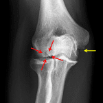 Red arrows: osteochondral lesion of the capitellum. Yellow arrow: remote avulsion fracture at the humeral attachment of the UCL.