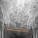 Subcapital right femoral neck fracture. Lines drawn between the lesser trochanters (red) and along the inferior margin of the obturator rings (yellow) diverge to the right, indicating that this is the side of impaction.