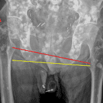 Lines drawn between the lesser trochanters (red line) and tangential to the inferior margins of the ischia (yellow line) diverge toward the right, indicating that this is the side of the impacted femoral neck fracture (red arrow).