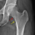 Femoral neck stress fracture with irregular sclerosis in the medial femoral neck (red arrow) and cortical irregularity along the inferior aspect.