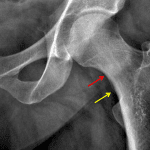 Femoral neck stress fracture evidenced by focal sclerosis in the medial femoral neck (red arrow) and apparent cortical step-off (yellow arrow), which may represent periosteal reaction.