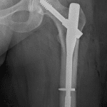 Postoperative radiograph in this patient.