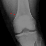 Distal femoral stress fracture: subtle cortical thickening along the medial aspect of the distal femoral metaphysis (red arrow).