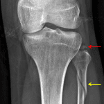 Arcuate complex avulsion fracture from the fibular head (red arrow) and oblique proximal fibular fracture (yellow arrow).