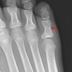 Red arrow: nondisplaced fifth proximal phalanx fracture with distal intraarticular extension.